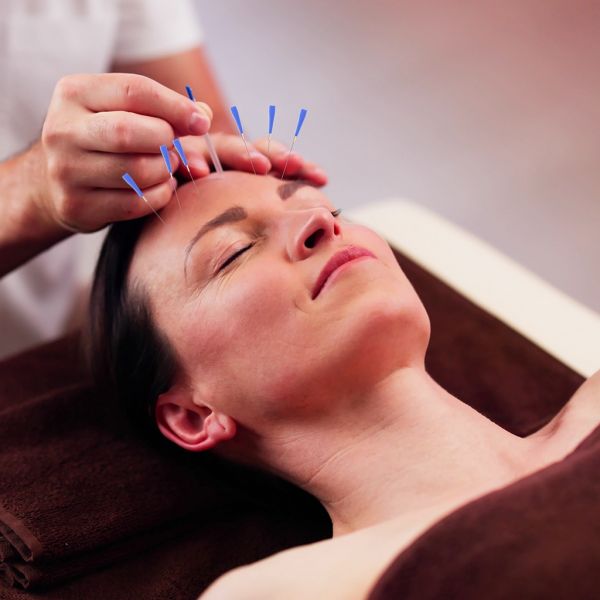 Frau liegt mit feinen Akupunkturnadeln im Gesicht zur Faltenminderung